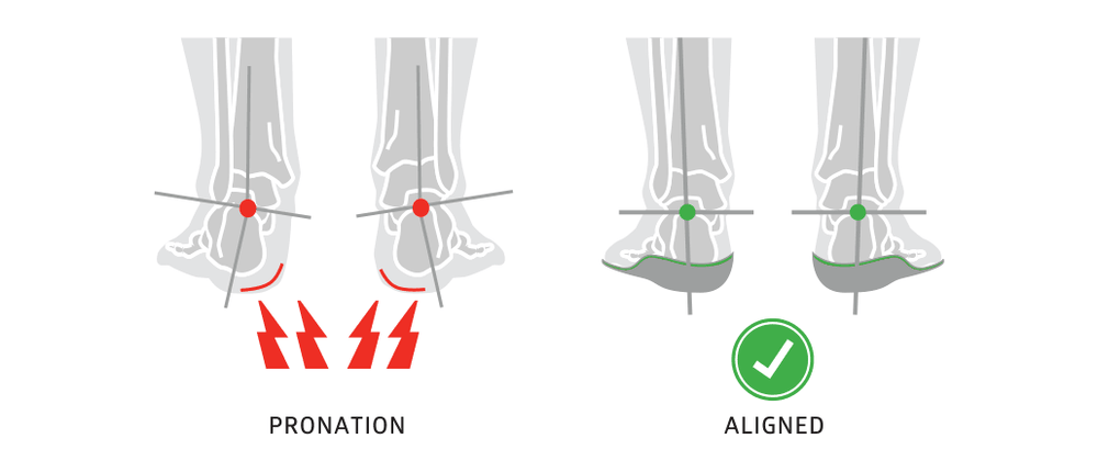 Over-Supination Explained